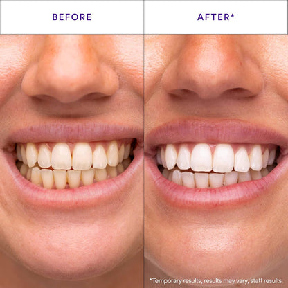 Purple V34 Teeth Whitening Strips - Tooth Stain Treatment, Combining Whitening and Colour Correction