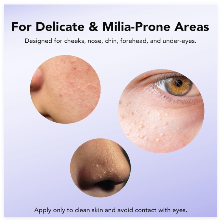MILIA REMOVER 30 mL Milia Remover Treatment